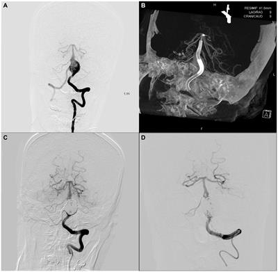 Flow diversion treatment for giant intracranial serpentine aneurysms